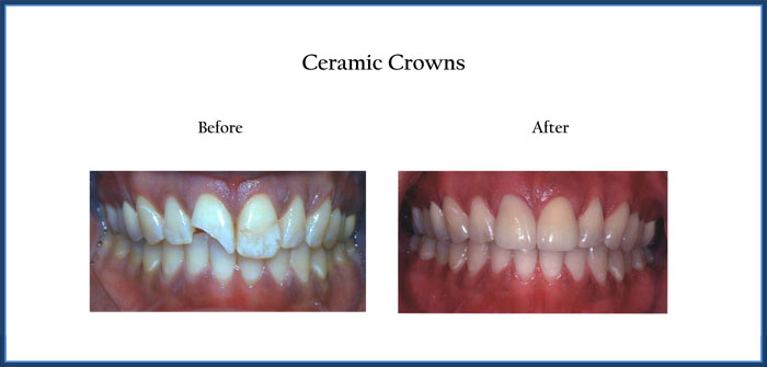 Ceramic Crowns